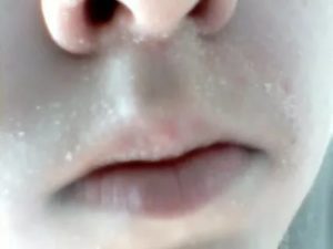 Шелушение над верхней губой с одной стороны белыми хлопьями
