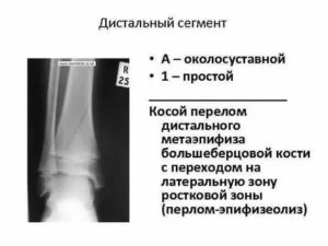 Перелом эпифиза большеберцовой кости