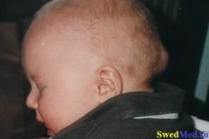 Шишка выпячивает над родничком