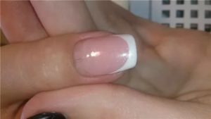 Трещина в ногте от кутикулы к окончанию ногтя