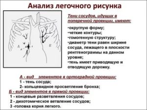 Сгущение легочного рисунка в базальных отделах