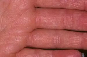 Мелкие сухие пузыри на коже рук