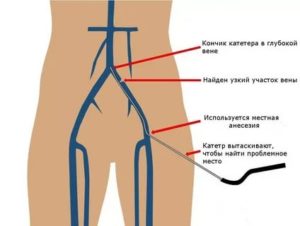 Варикоз малого таза. Боли