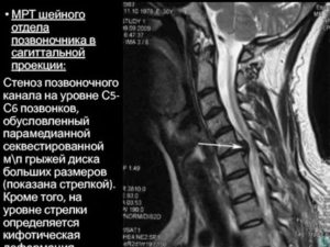 Грыжа диска С5-С6