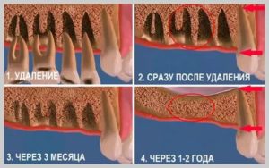 Оголение кости после удаления зуба
