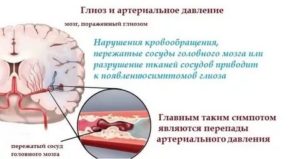 Супратенториальные очаги глиоза