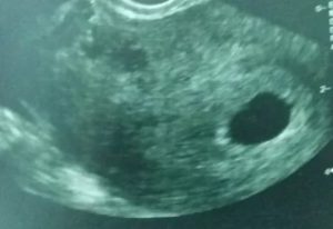 Анэмбриония на сроке 6 недель