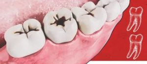 Кровоточивость на месте разрушенного зуба