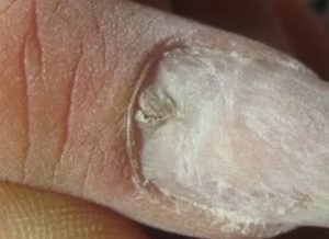 Повреждение матрикса ногтя