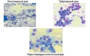 Лечение слизистого рака молочной железы