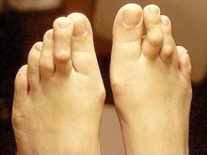 Шишка на среднем пальце ноги