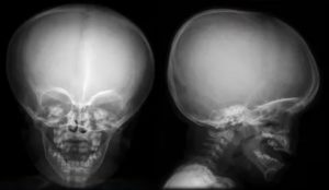 Рентген головы ребенка