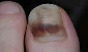 Кровоизлияния под ногтями и ногти отходят от ложа