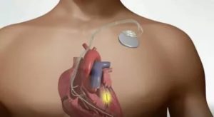 Аппарат кардиовертер-дефибриллятор