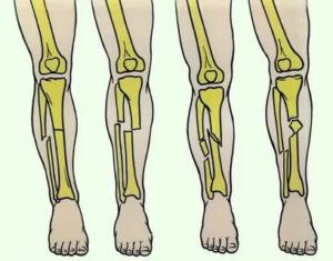 Онемение после перелома большой берцовой кости ноги