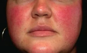 Аллергия с волдырем на метронидазол