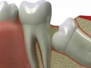 Оголение кости после удаления зуба