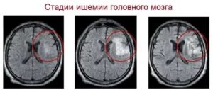 Ишемия головного мозга