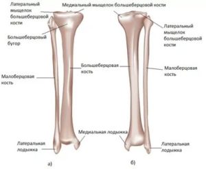 Перелом эпифиза большеберцовой кости