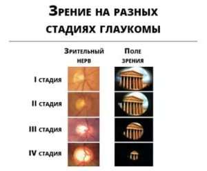 Глаукома 4 стадии, операция по улучшению зрения