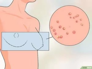 Розовый лишай лечение при кормлении грудью