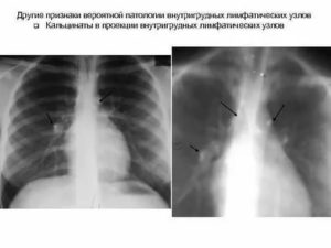 Кальцинаты в лимфоузлах легкого у ребенка