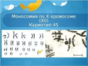 Моносомия хромосомы Х