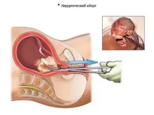 Медикаментозный аборт при внематочной беременности