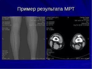 Результаты МРТ