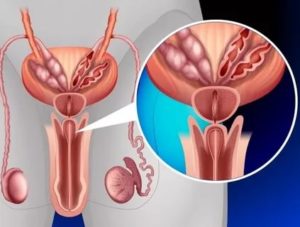 Спазмы в предстательной железе