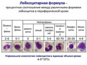 Увеличение общих лейкоцитов в крови без изменения лейкоцитарной формулы