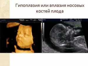 Гипоплазия носовой кости