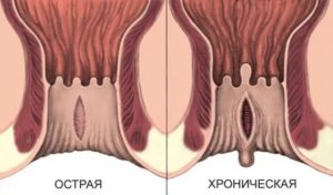 Трещина в заднем проходе