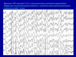 Плахое ЭЭГ, при задержке речевого развития
