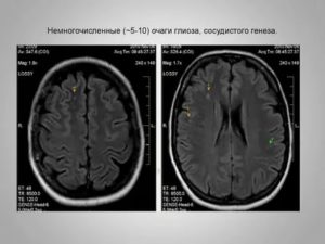 Супратенториальные очаги глиоза