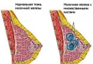 Боль в груди и выделения из соска