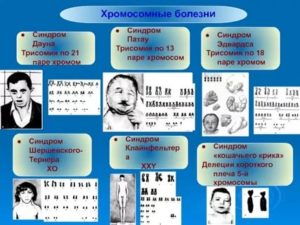 Трисомия по 7 хромосоме