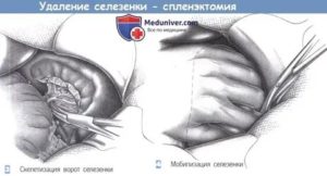 Спленэктомия и новая селезёнка