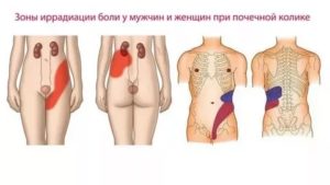 Боль при нажатии на правую почку