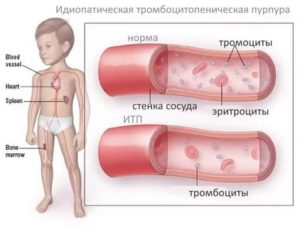 Тромбоцитопатия у ребенка