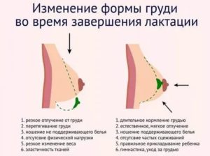 Грудь неправильной формы