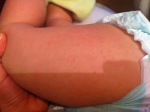 Сыпь на попе у ребенка