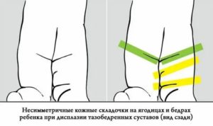 Пропала ягодичная складка