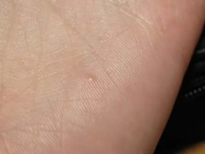 Мелкие сухие пузыри на коже рук