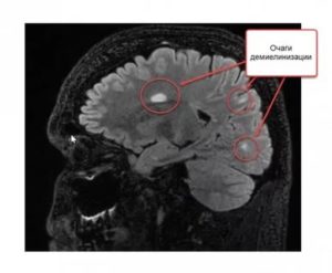 Очаги демиелинизации
