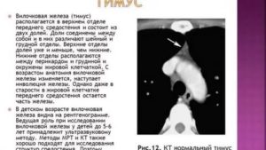 Расшифровка КТ вилочковой железы