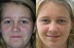 Сыпь на лице у девочки 14 лет