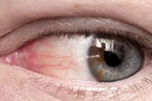 Красные сосуды на белках глаз