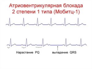 АБ блокада 2йстепени 1-го типа