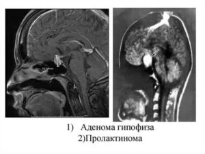Пролактин и опухоли гипофиза